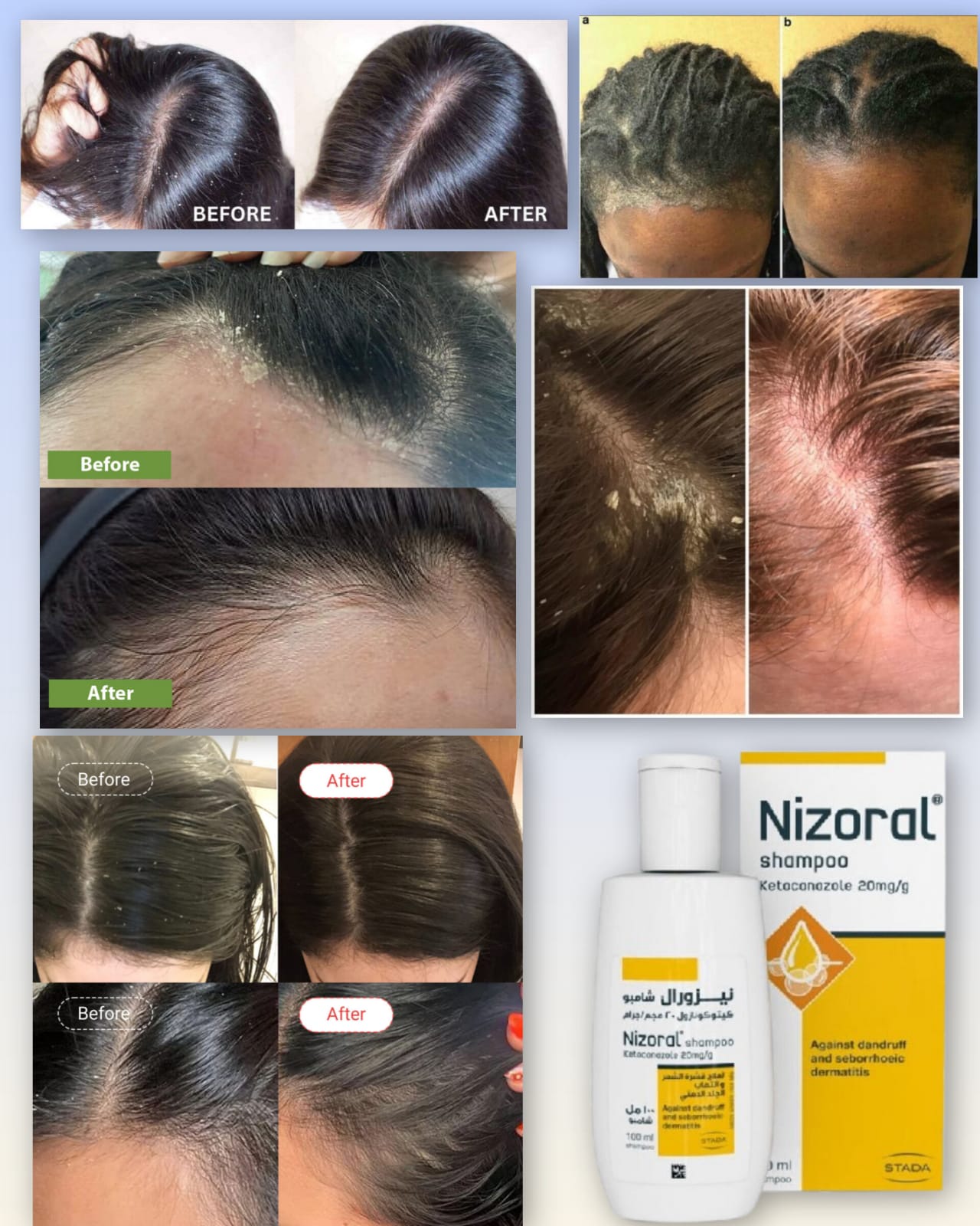 Nizoral Anti-Dandruff Shampoo with 2% Ketoconazole
